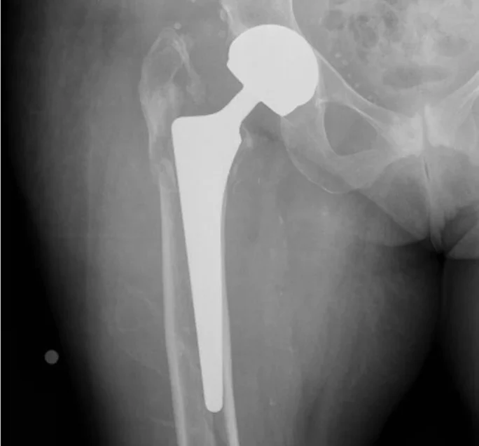 Periprosthetic femoral fractures in Total Hip Arthroplasty (THA)